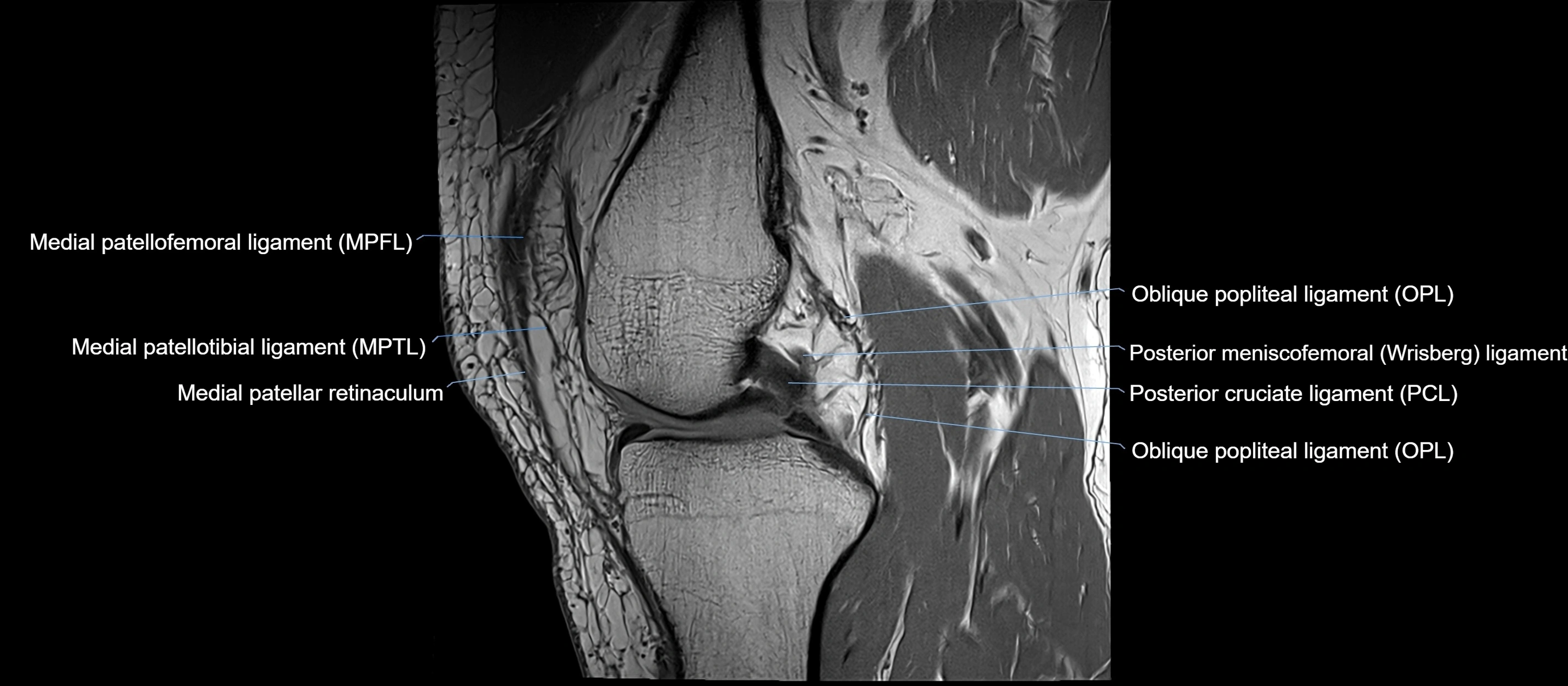 MRI sagittal  ligaments cross sectional anatomy 3T  radiology  image-img-00001-00021.webp